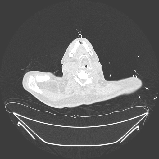 Aortic arch aneurysm (Radiopaedia 84109-99365 Axial lung window 6).jpg
