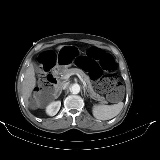 Aortic dissection- Stanford type A (Radiopaedia 22085-22085 A 43).jpg