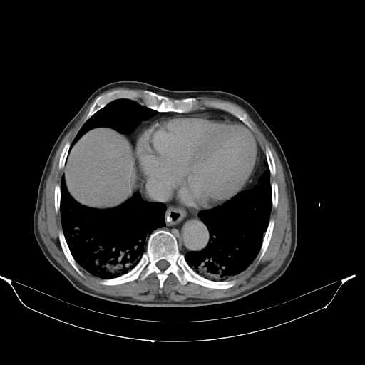 File:Aortic dissection- Stanford type A (Radiopaedia 22085-22085 Axial C+ delayed 3).jpg