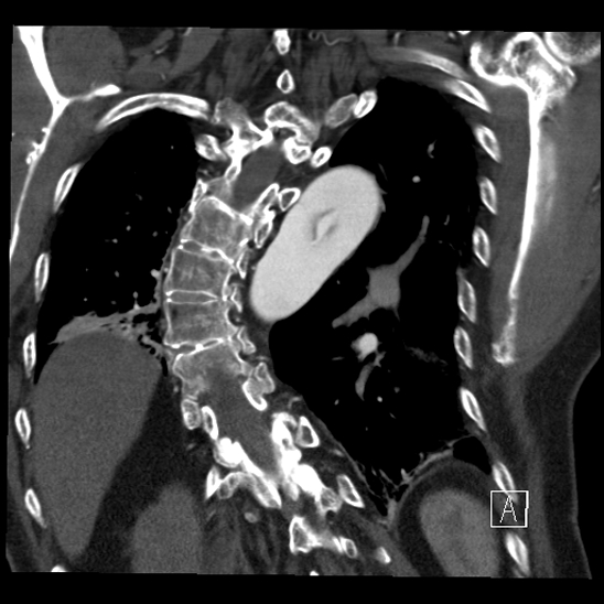 File:Aortic dissection (CTPA) (Radiopaedia 75506-86750 B 57).jpg