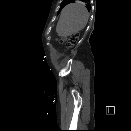 Aortic dissection (CTPA) (Radiopaedia 75506-86750 G 14).jpg