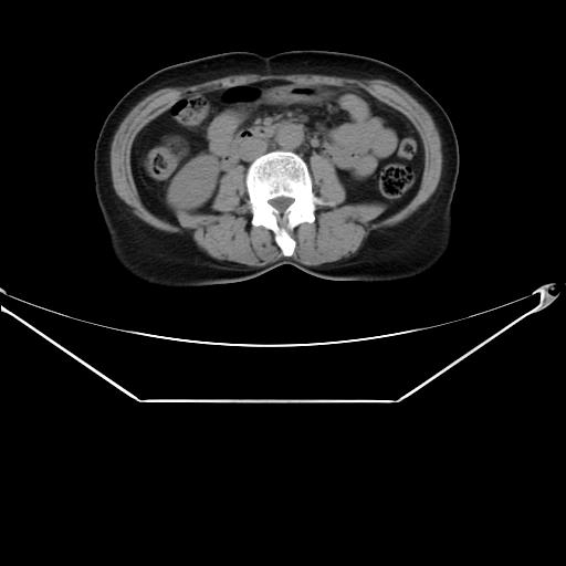File:Aortic dissection (Radiopaedia 25350-25604 B 52).jpg