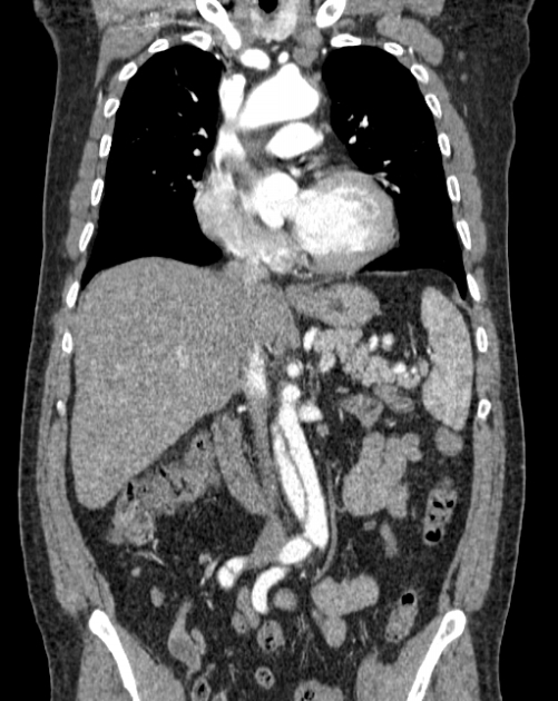 Aortic dissection (Radiopaedia 44411-48061 A 19).jpg