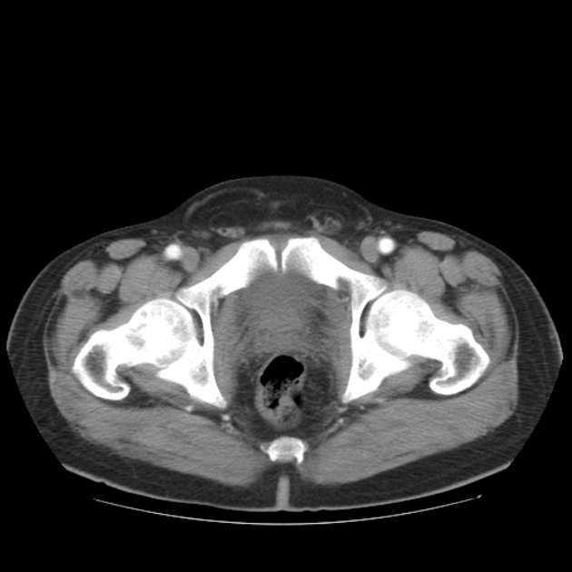 Aortic dissection (Radiopaedia 44411-48061 C 57).jpg