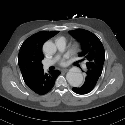 Aortic dissection (Radiopaedia 50763-56234 A 30).png