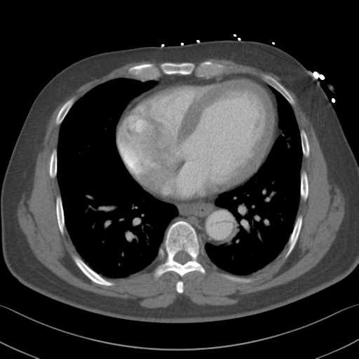 File:Aortic dissection (Radiopaedia 50763-56234 A 46).png