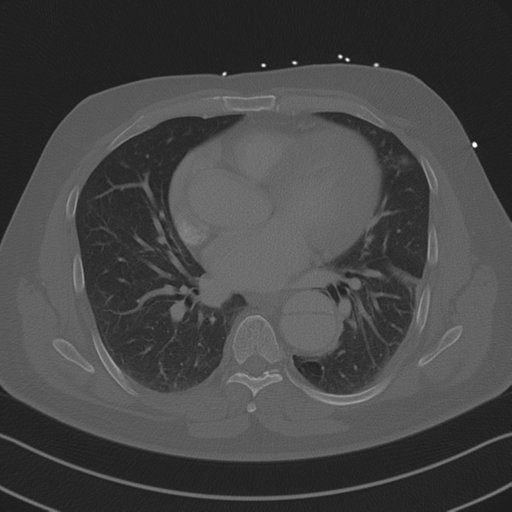 Aortic dissection (Radiopaedia 50763-56234 Axial bone window 60).png