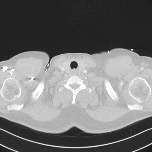 File:Aortic dissection (Radiopaedia 50763-56234 Axial lung window 6).png