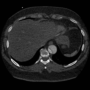 Aortic dissection (Radiopaedia 57969-64959 A 250).jpg
