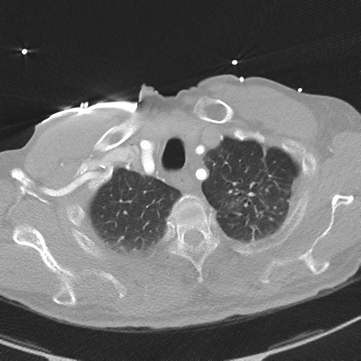 File:Aortic dissection - DeBakey type II (Radiopaedia 64302-73082 Axial lung window 10).png