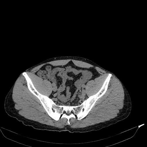 File:Aortic dissection - Stanford type A (Radiopaedia 83418-98500 Axial non-contrast 79).jpg