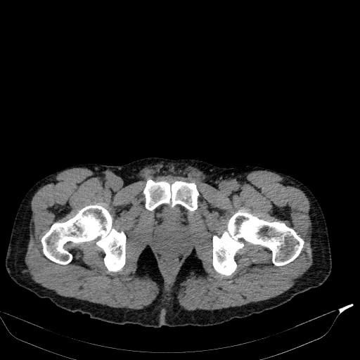Aortic dissection - Stanford type A (Radiopaedia 83418-98500 Axial non-contrast 93).jpg