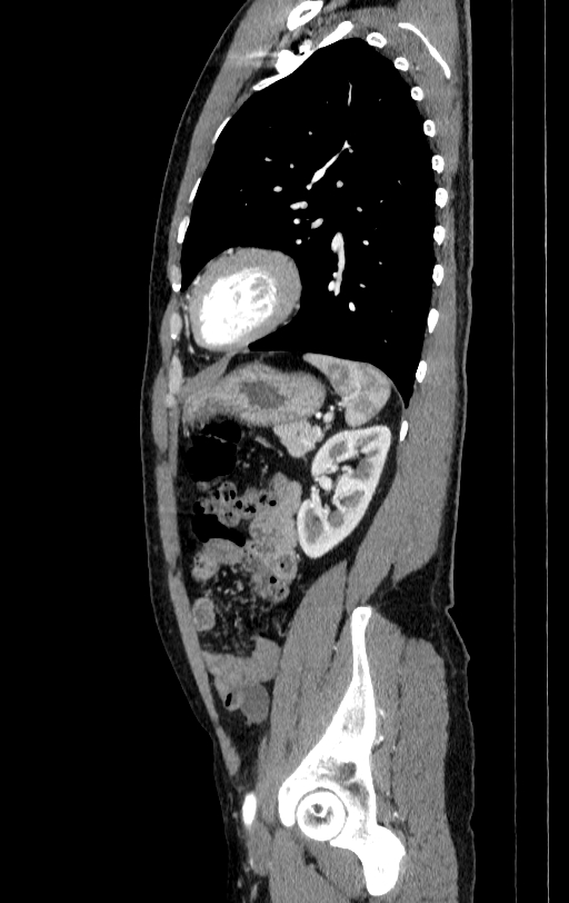 Aortic dissection - Stanford type A (Radiopaedia 83418-98500 B 76).jpg