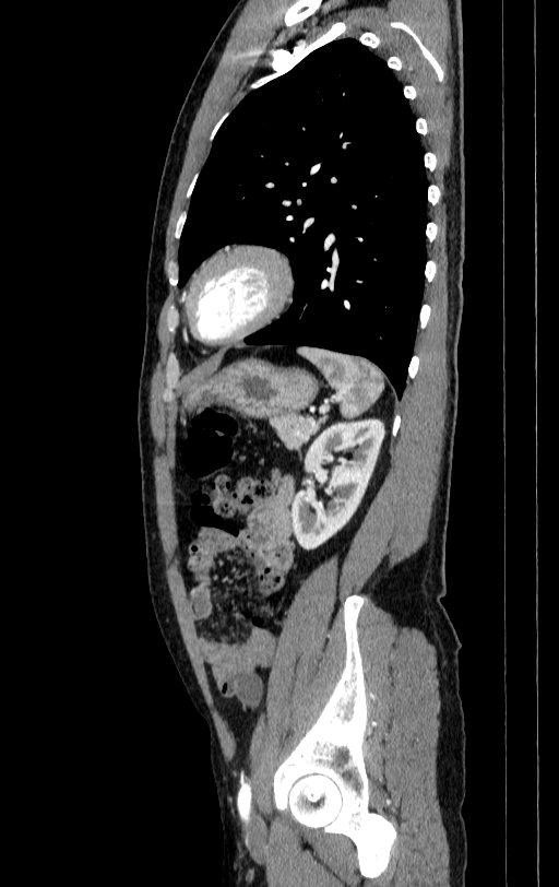 Aortic dissection - Stanford type A (Radiopaedia 83418-98500 B 77).jpg