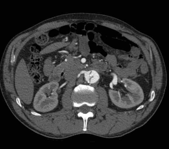 Aortic dissection - Stanford type B (Radiopaedia 73648-84437 A 147).jpg