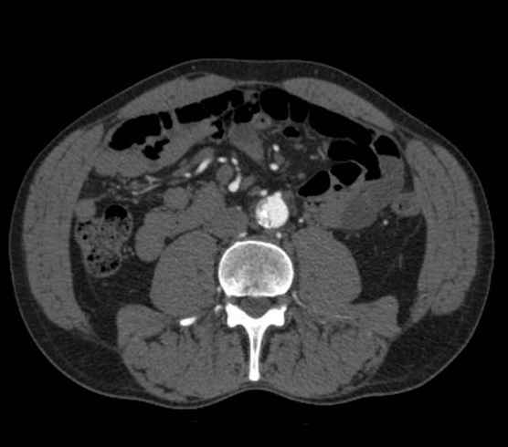 Aortic dissection - Stanford type B (Radiopaedia 73648-84437 A 175).jpg