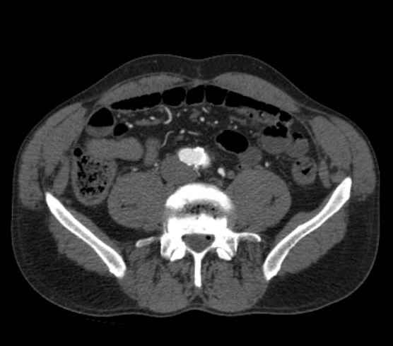 File:Aortic dissection - Stanford type B (Radiopaedia 73648-84437 A 197).jpg