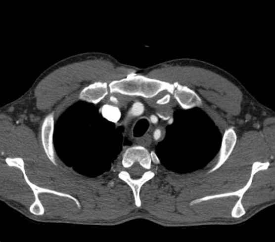 File:Aortic dissection - Stanford type B (Radiopaedia 73648-84437 A 3).jpg