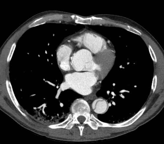 File:Aortic dissection - Stanford type B (Radiopaedia 73648-84437 A 66).jpg