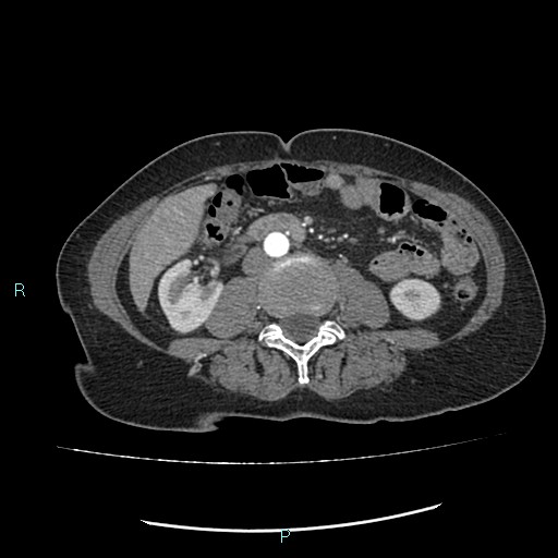 File:Aortic dissection extended to lusory artery (Radiopaedia 43686-47136 B 19).jpg