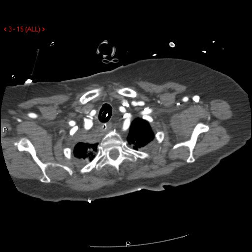 Aortic intramural hematoma (Radiopaedia 27746-28001 A 15).jpg