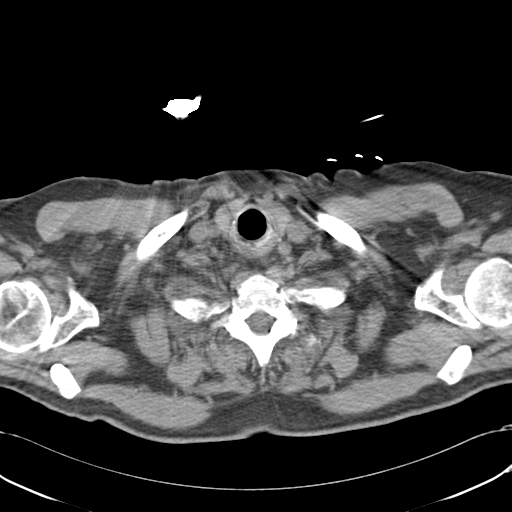 Aortic intramural hematoma (Radiopaedia 34260-35540 Axial non-contrast 4).png