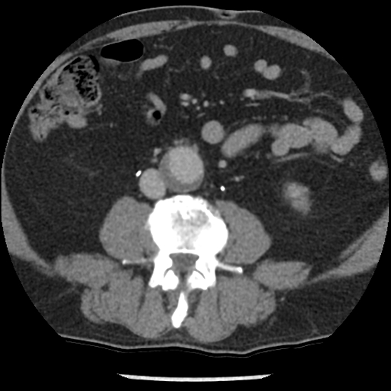 File:Aortic intramural hematoma (type B) (Radiopaedia 79323-92387 Axial C+ delayed 79).jpg