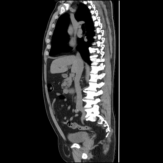 Aortic intramural hematoma (type B) (Radiopaedia 79323-92387 G 20).jpg