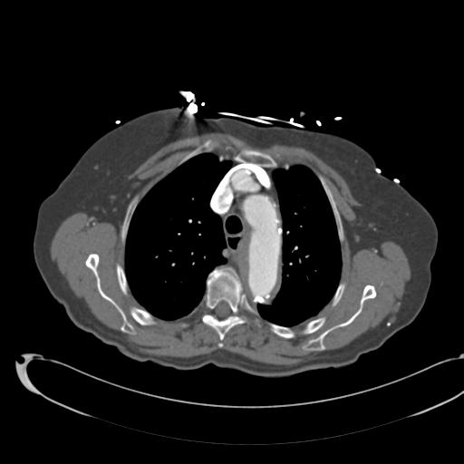 File:Aortic intramural hematoma from penetrating atherosclerotic ulcer (Radiopaedia 31137-31836 B 30).jpg