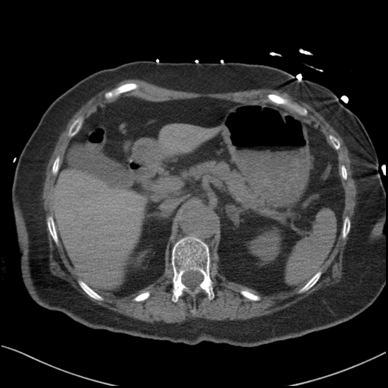 Aortic intramural hematoma with dissection and intramural blood pool (Radiopaedia 77373-89491 Axial non-contrast 100).jpg