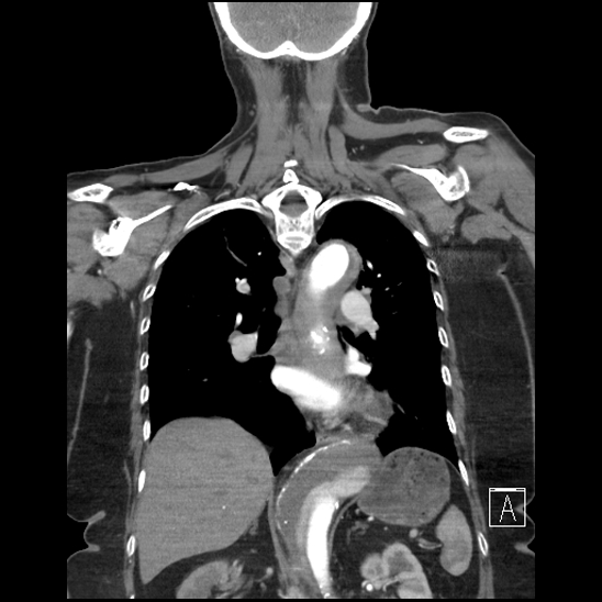 Aortic intramural hematoma with dissection and intramural blood pool (Radiopaedia 77373-89491 C 39).jpg