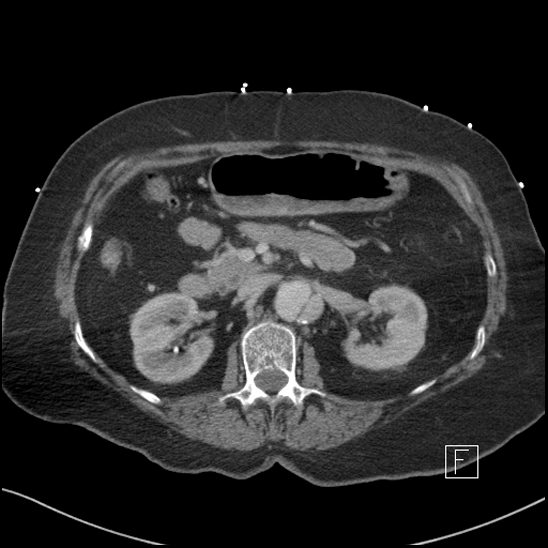 Aortic intramural hematoma with dissection and intramural blood pool (Radiopaedia 77373-89491 E 25).jpg