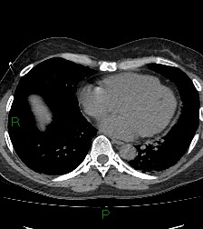 Aortic valve endocarditis (Radiopaedia 87209-103485 Axial non-contrast 67).jpg