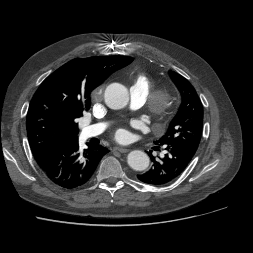 File:Aorto-coronary bypass graft aneurysms (Radiopaedia 40562-43157 A 57).png