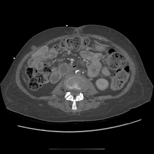 Aorto-duodenal fistula (Radiopaedia 25668-25850 A 43).jpg