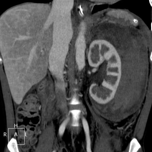 Aorto-left renal vein fistula (Radiopaedia 45534-49628 B 36).jpg