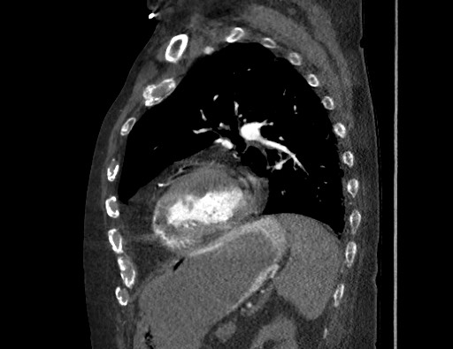 File:Aortoesophageal fistula with endovascular repair (Radiopaedia 73781-84592 Sagittal C+ CTPA 137).jpg
