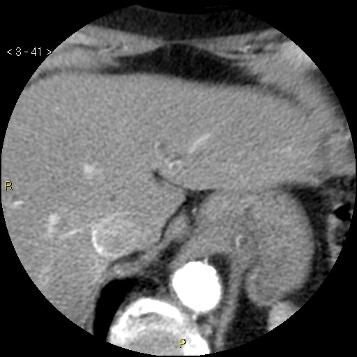 Aortoiliac occlusive disease (Radiopaedia 16828-16548 A 41).jpg