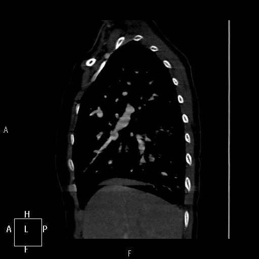File:Aortopulmonary septal defect (Radiopaedia 41990-45013 Sagittal C+ CTPA 49).jpg