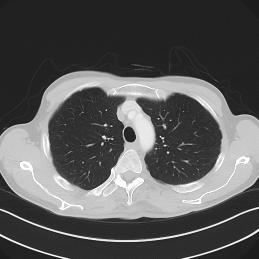 Apical pleural calcification (Radiopaedia 46141-50499 Axial lung window 19).png