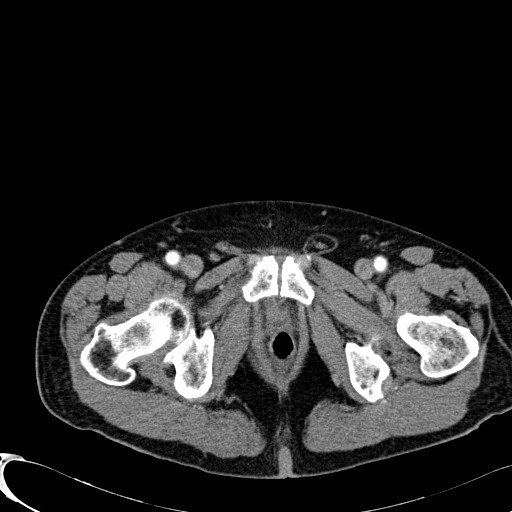 Appendiceal adenocarcinoma complicated by retroperitoneal abscess (Radiopaedia 58007-65039 B 144).jpg