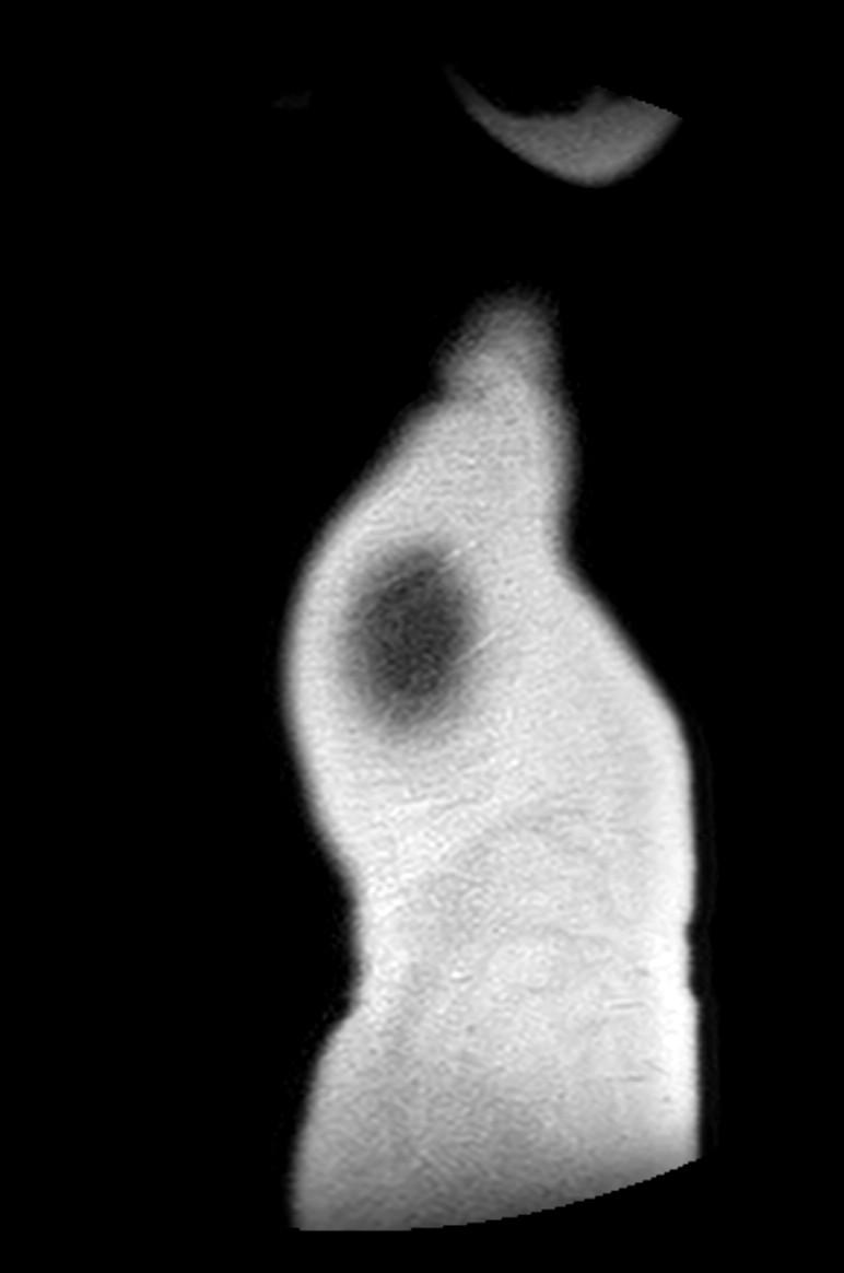 Appendicitis in gravida (MRI) (Radiopaedia 89433-106395 Sagittal T2 64).jpg