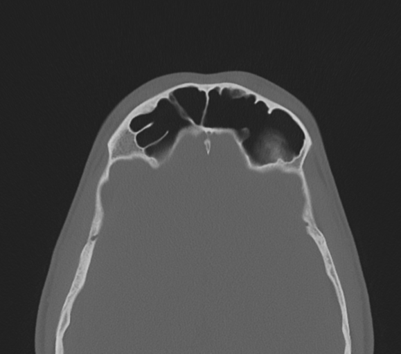 File:Arachnoid cyst - cerebellopontine angle (Radiopaedia 59689-67082 Axial bone window 34).png