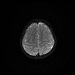Arachnoid cyst - middle cranial fossa (Radiopaedia 86780-102938 Axial DWI 34).jpg