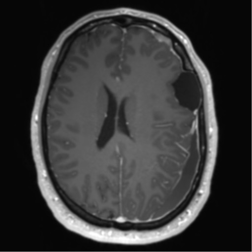 Arachnoid cyst with subdural hematoma (Radiopaedia 85892-101743 Axial T1 C+ 54).png