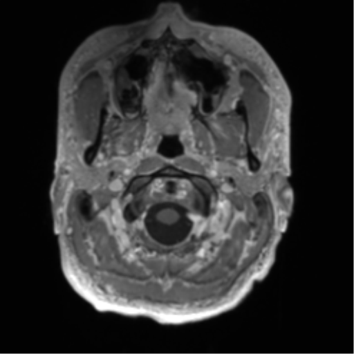 Arachnoid cyst with subdural hematoma (Radiopaedia 85892-101743 Axial T1 C+ 7).png