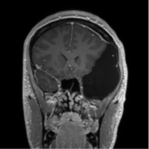 Arachnoid cyst with subdural hematoma (Radiopaedia 85892-101743 Coronal T1 C+ 64).png