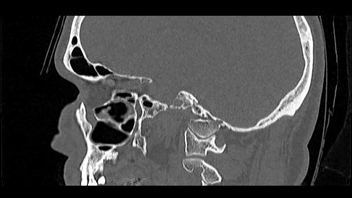 Arcuate foramen (Radiopaedia 89833-106944 Sagittal bone window 26).jpg