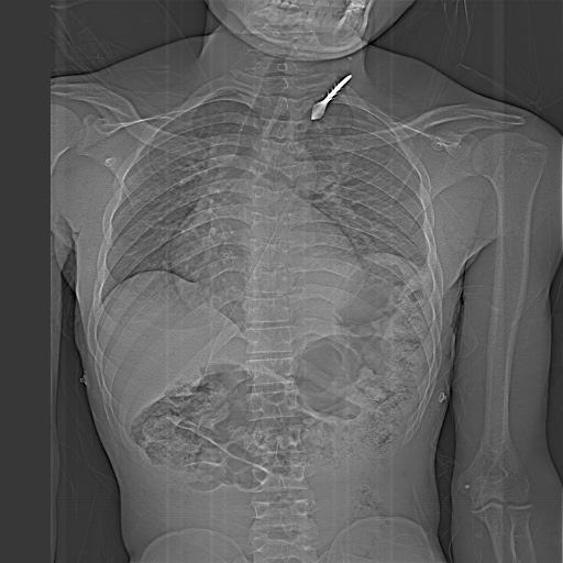 File:Arrow injury in the neck (Radiopaedia 75268-86390 Coronal Localizer 1).jpg
