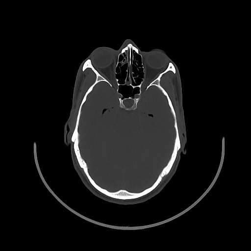 Arrow injury to the brain (Radiopaedia 72101-82607 Axial bone window 63).jpg